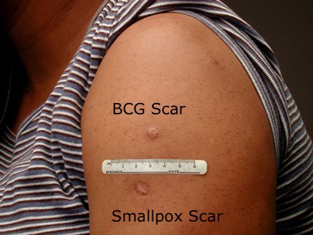 BCG Vaccine scar