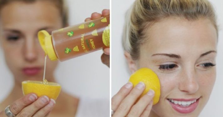 6 Natural ways to get rid of white and blackheads in few days